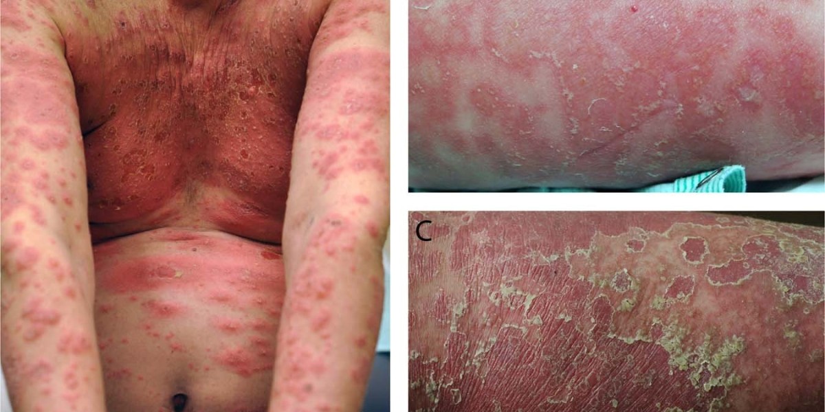 Unknown genetic connection found in cases of widespread pustular psoriasis